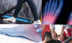 Halluks Valgus Ameliyatsız Nasıl Tedavi Edilir?