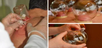 Kan Vermek İle Hacamat Arasındaki Fark Nedir